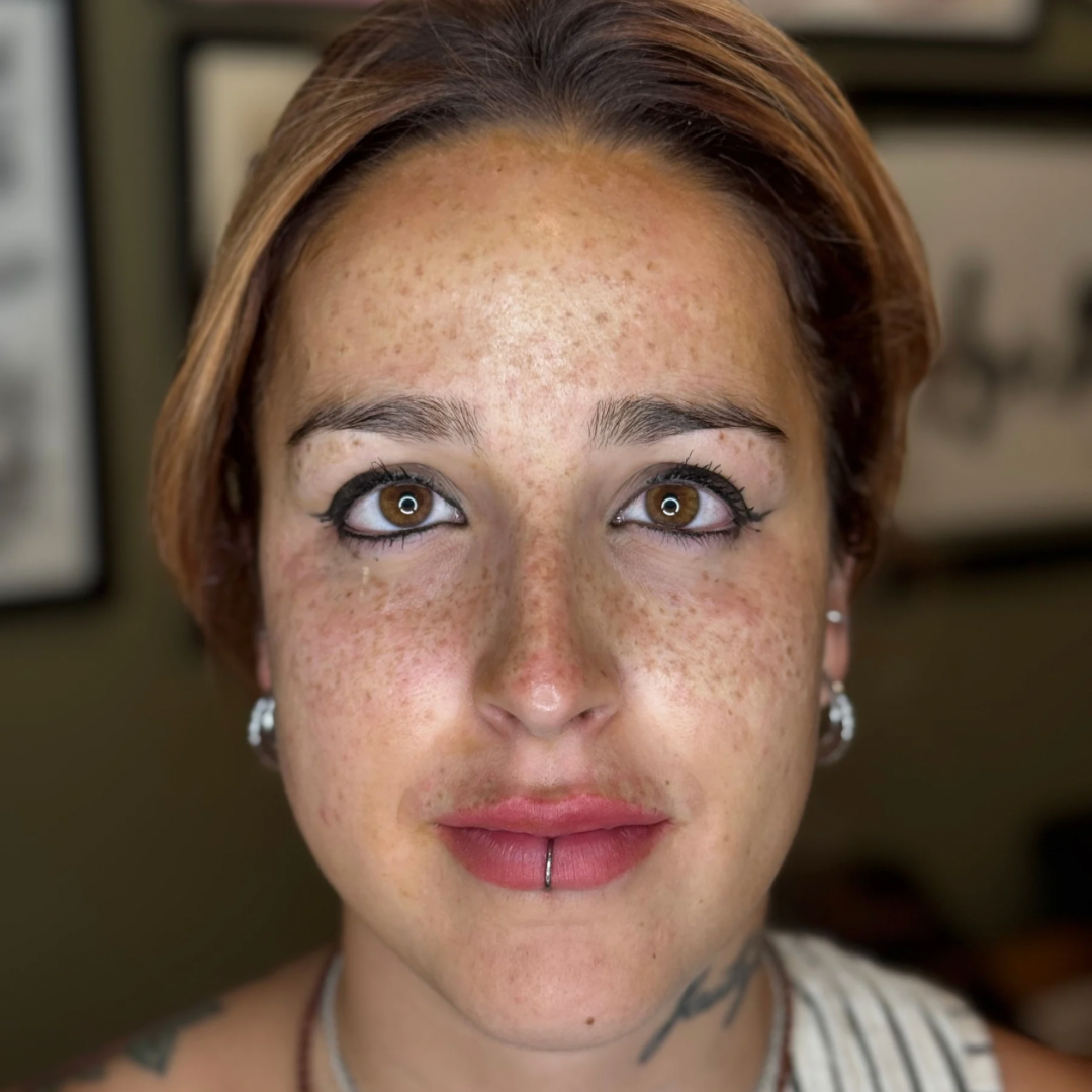 after freckles / na sproetjes behandeling