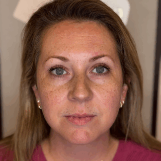 faux freckles haarlem